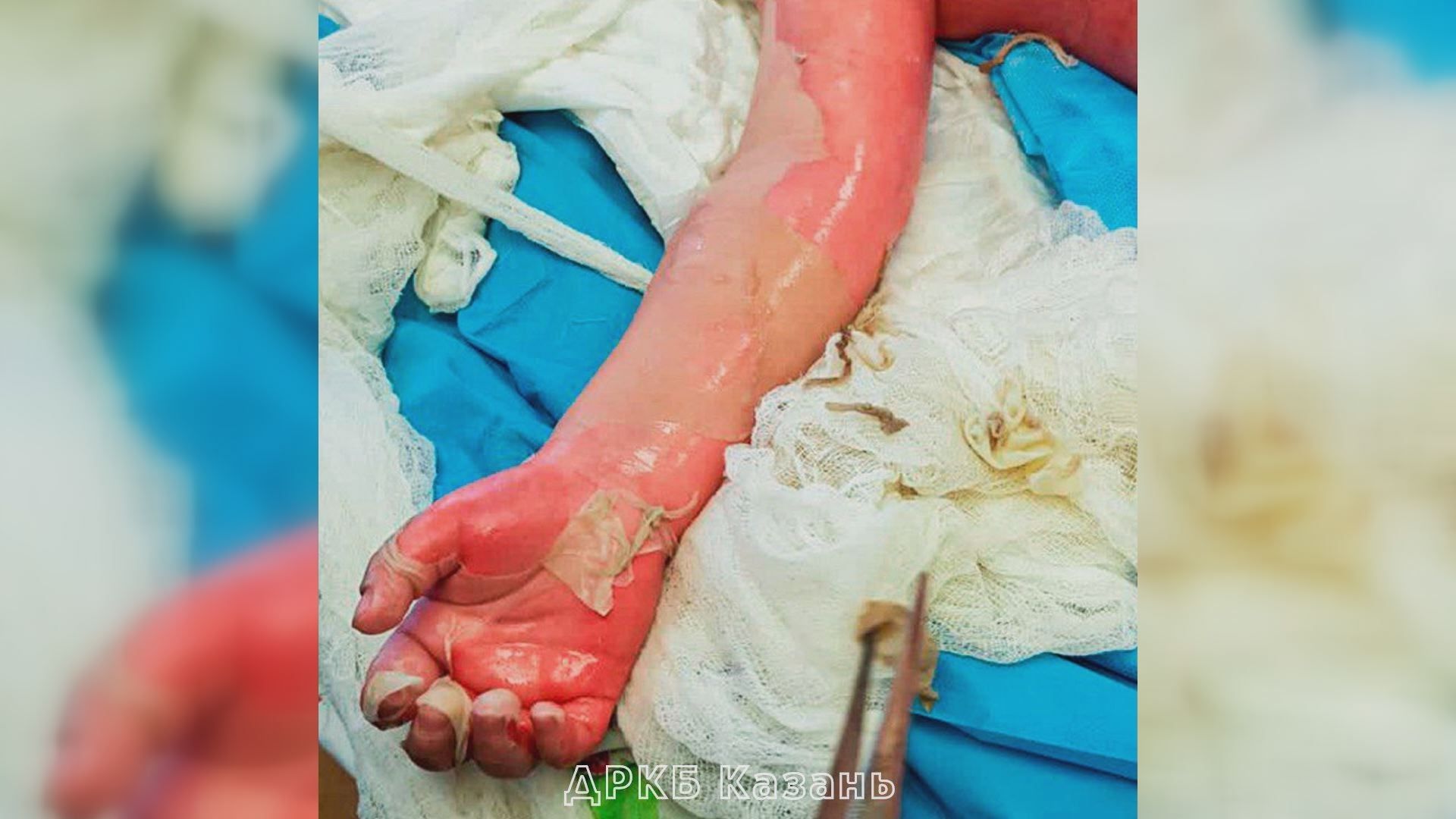 В Татарстане двухгодовалый ребенок получил ожоги 73% тела
