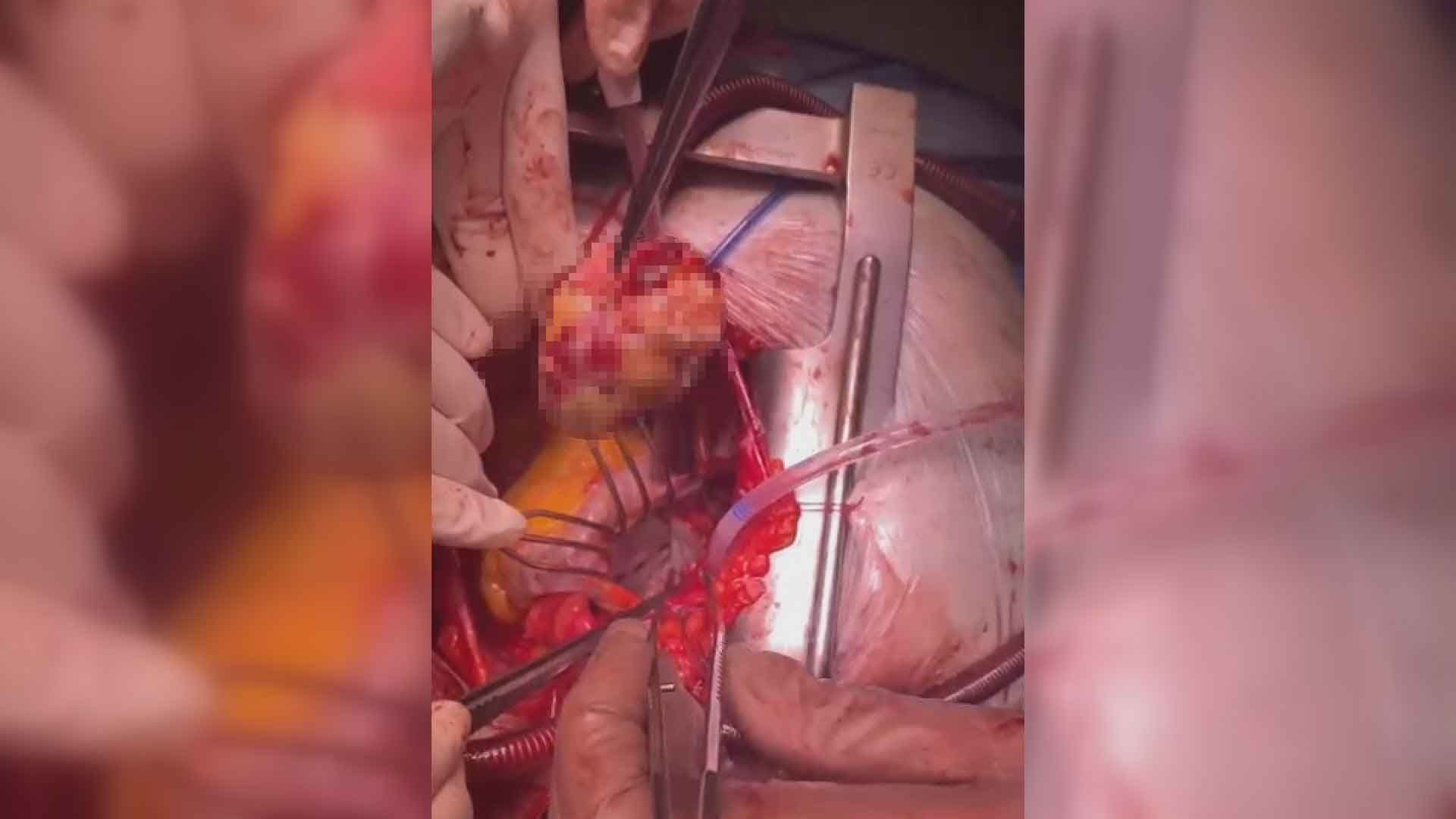 Челнинские врачи удалили у пациентки опухоль, занимавшую почти все сердце