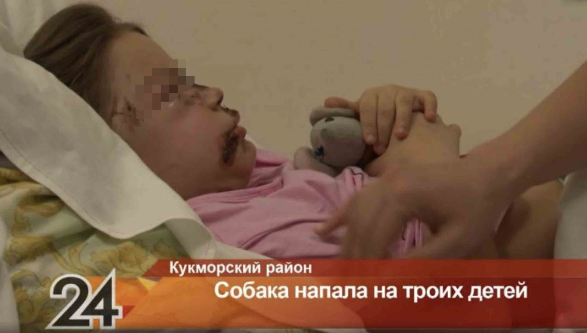 Девочку, которой собака разодрала лицо в Татарстане, выписали из больницы