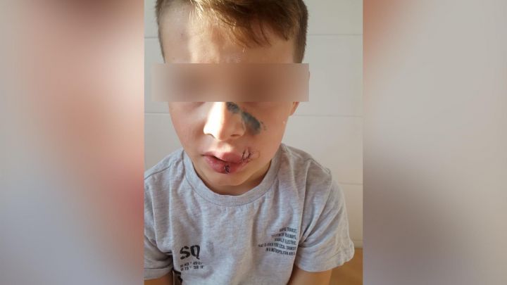 По факту нападения собаки на мальчика в Казани возбуждено уголовное дело