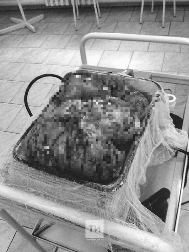 В Челнах врачи удалили пациентке опухоль весом 3,5 кг