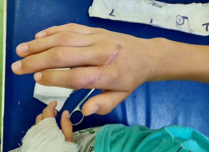 Врачи РКБ спасли 13-летней девочке палец, разрезанный болгаркой