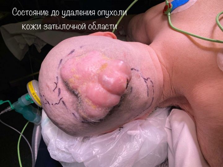 В БСМП Челнов пациентке удалили 10-сантиметровую опухоль на голове