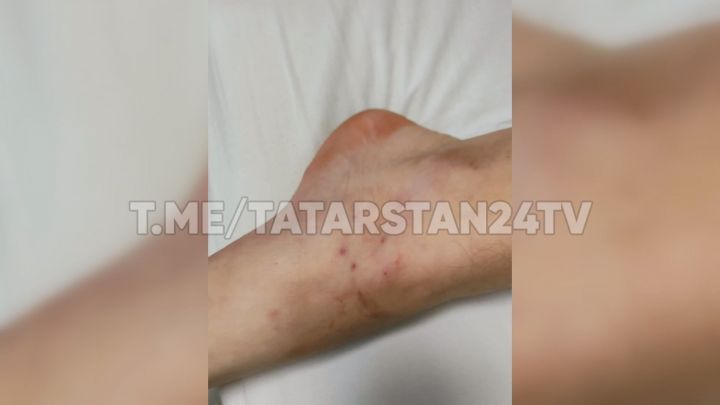 13-летний мальчик попал в больницу после укуса змеи в Казани