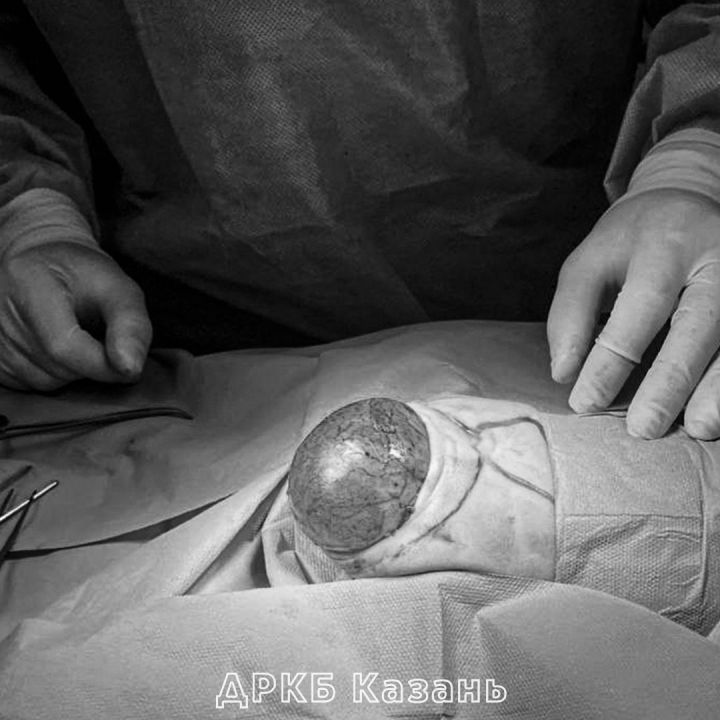 Казанские врачи удалили большую опухоль у новорождённого ребенка