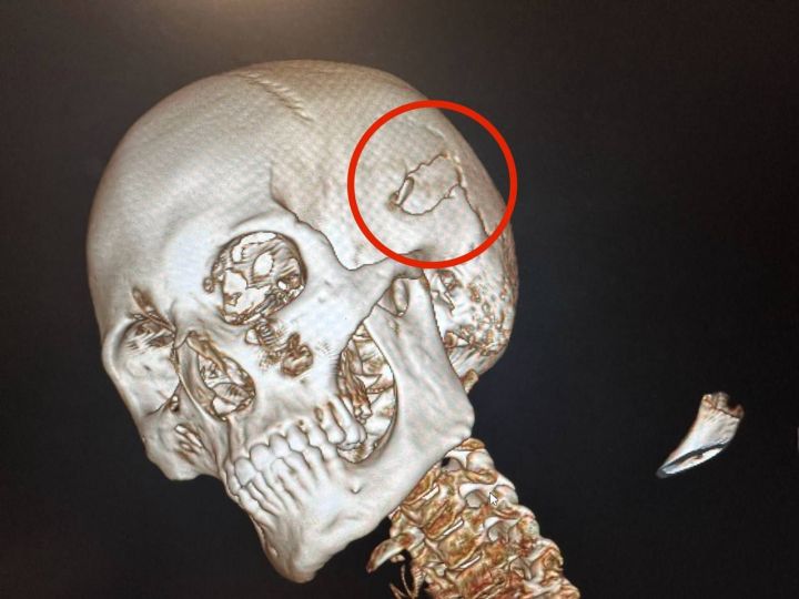 В РТ мужчине потребовалась операция после падения на него металлических ворот