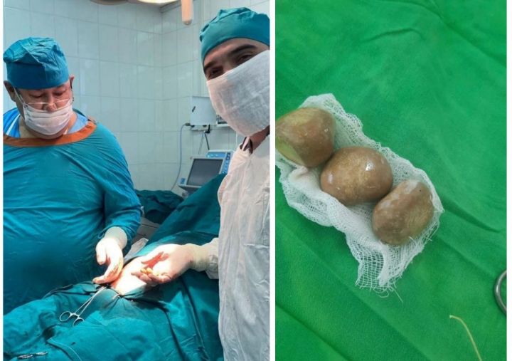 Врачи в Татарстане спасли 74-летнего мужчину, удалив камни размером с перепелиные яйца